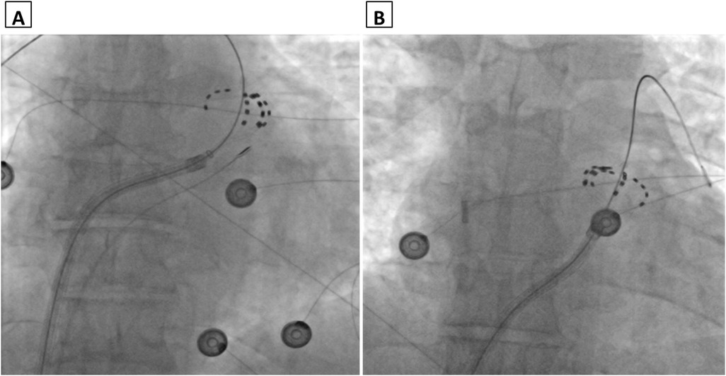Two grayscale X-ray images labeled A and B. In Panel A, a curved catheter with multiple dark electrode markers is visible, ending in a compact, rounded shape with several looping arms forming a globular structure. Panel B shows a similar catheter with the tip fully opened into a flower-like, radial pattern of five petal-shaped loops. Several circular radiopaque markers and overlapping guidewires appear in the background of both panels.