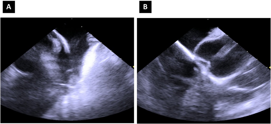Two black-and-white ultrasound images labeled A and B. In both images, a tubular structure is visible extending from the top right toward the center of the frame. In Panel A, the structure appears as a rounded shape with slight shadowing against a grainy background. In Panel B, the structure has a flatter appearance, pressing against a brighter curved surface. The background in both panels contains layered grayscale textures with low contrast.