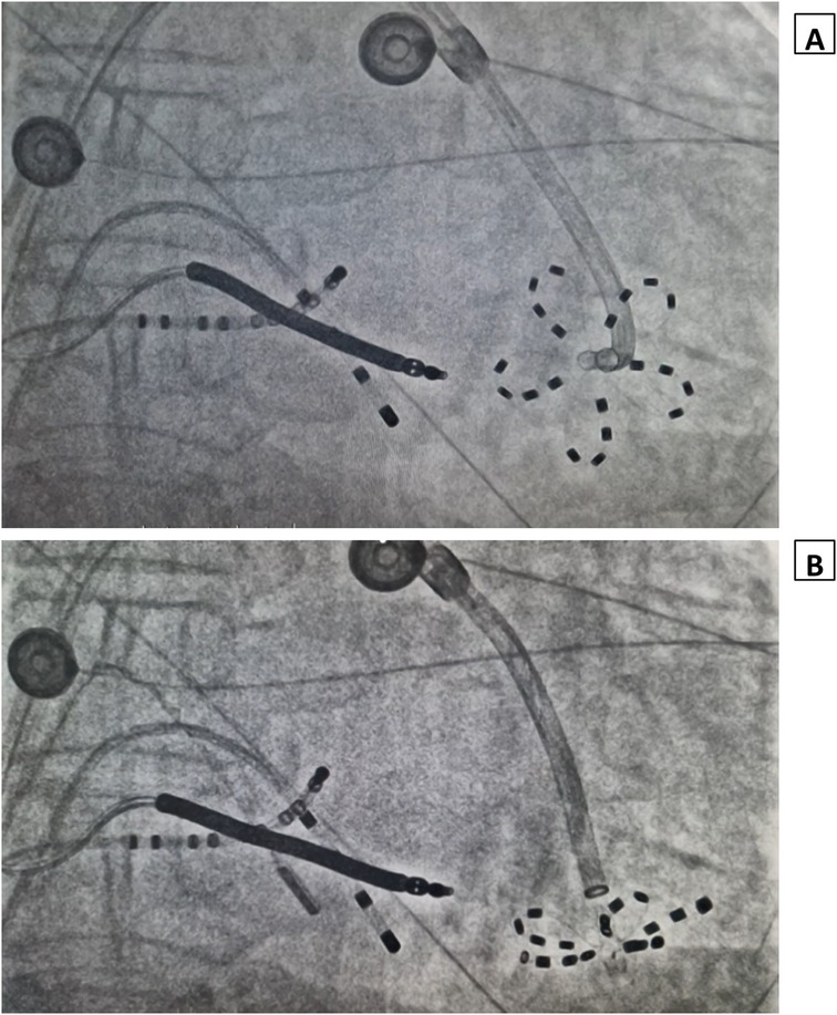Two X-ray panels labeled A and B. In Panel A, a catheter is visible in the lower right, with the tip opened into a five-lobed flower-like shape formed by looping electrode arms. In Panel B, the same catheter appears slightly repositioned, with its tip again spread into five visible loops. Several linear structures, wires, and circular markers are scattered across both panels.