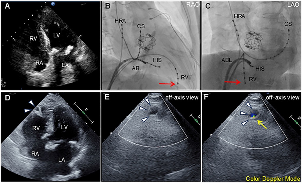 Panel A shows an echocardiogram with labeled heart chambers: right ventricle (RV), left ventricle (LV), right atrium (RA), and left atrium (LA). Panels B and C show cardiac catheterization images with labeled areas: high right atrium (HRA), coronary sinus (CS), His bundle (HIS), ablation catheter (ABL), and right ventricle (RV), with red arrows indicating catheter direction. Panel D shows an echocardiogram of heart chambers. Panels E and F display off-axis echocardiography views with blue arrowheads highlighting a structure, and panel F includes a yellow arrow indicating Doppler flow.