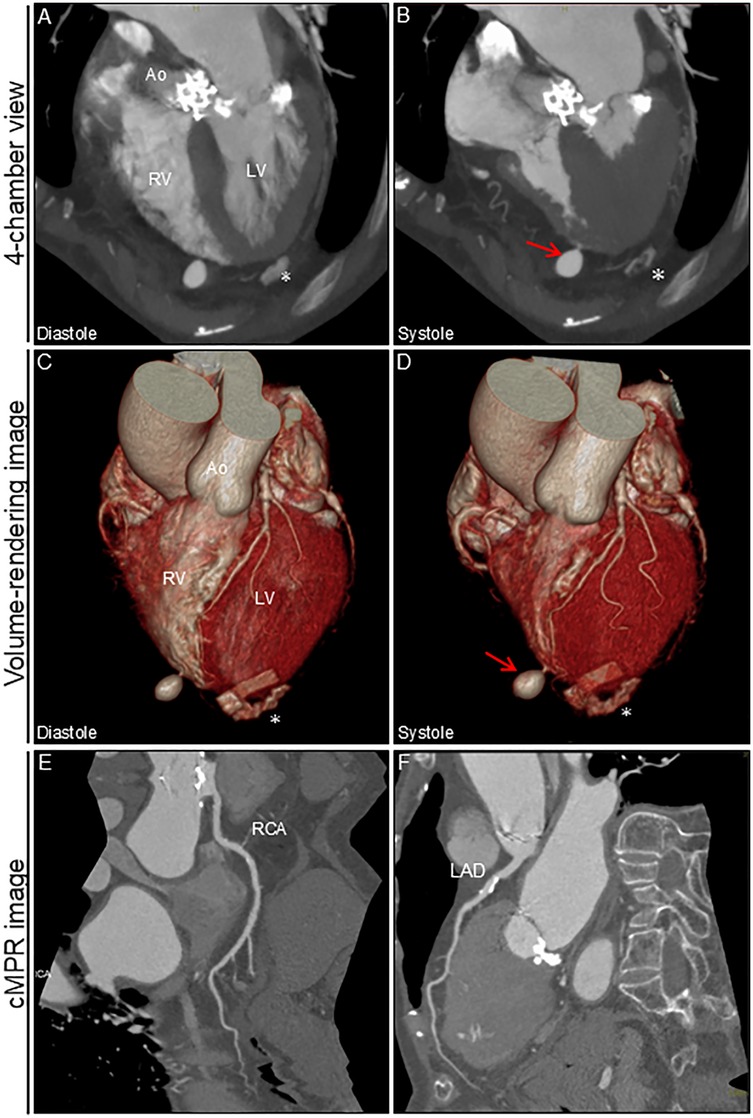 CT images of the heart in various views: Panels A and B show four-chamber views during diastole and systole, highlighting the right (RV) and left ventricles (LV), and the aorta (Ao). Panel B has a red arrow pointing to a structure. Panels C and D are volume-rendered images during diastole and systole, with a focus on the ventricular structure. Panel D includes a red arrow indicating a specific area. Panels E and F show cMPR images of the coronary arteries, labeled RCA and LAD.