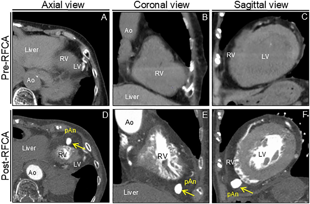 CT scan images showing cardiac views pre- and post-radiofrequency catheter ablation (RFCA). The top row (A-C) displays axial, coronal, and sagittal views pre-RFCA, highlighting the aorta (Ao), right ventricle (RV), left ventricle (LV), and liver. The bottom row (D-F) shows the same views post-RFCA, with yellow arrows indicating a lesion marked as pAn. Changes in the cardiac structure are observable post-treatment.