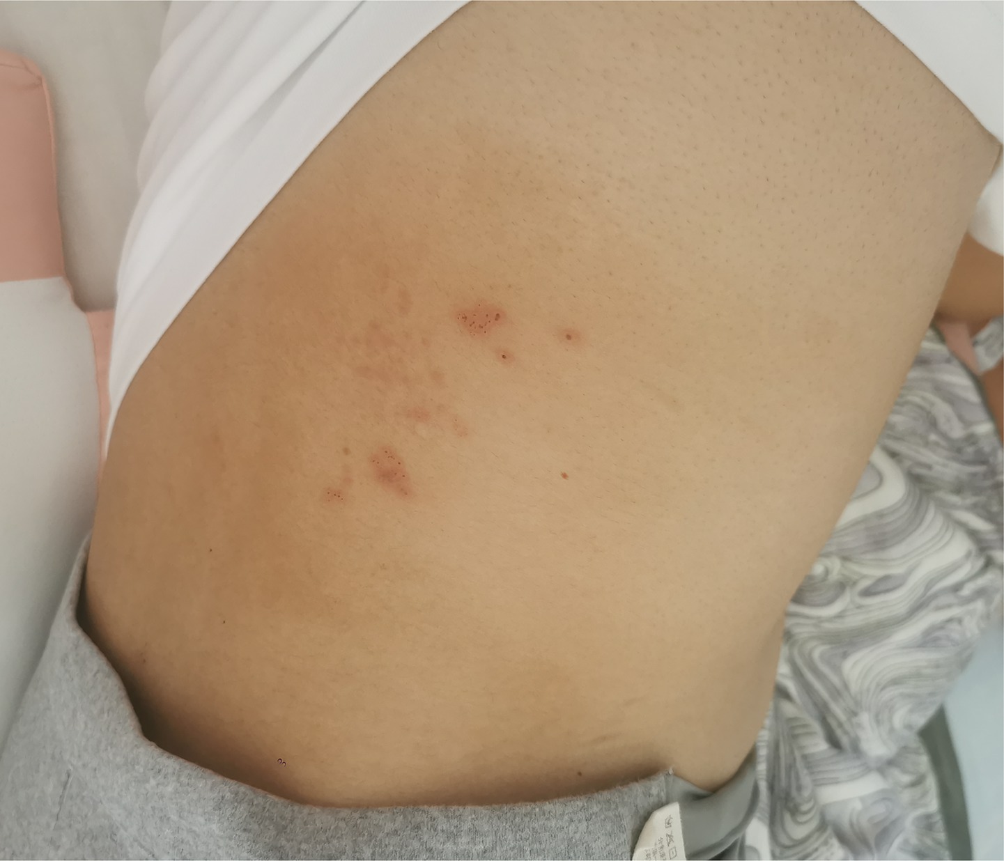Red, raised spots on a person's skin, located on the side of the torso near the ribs. The surrounding skin appears smooth and light in tone.