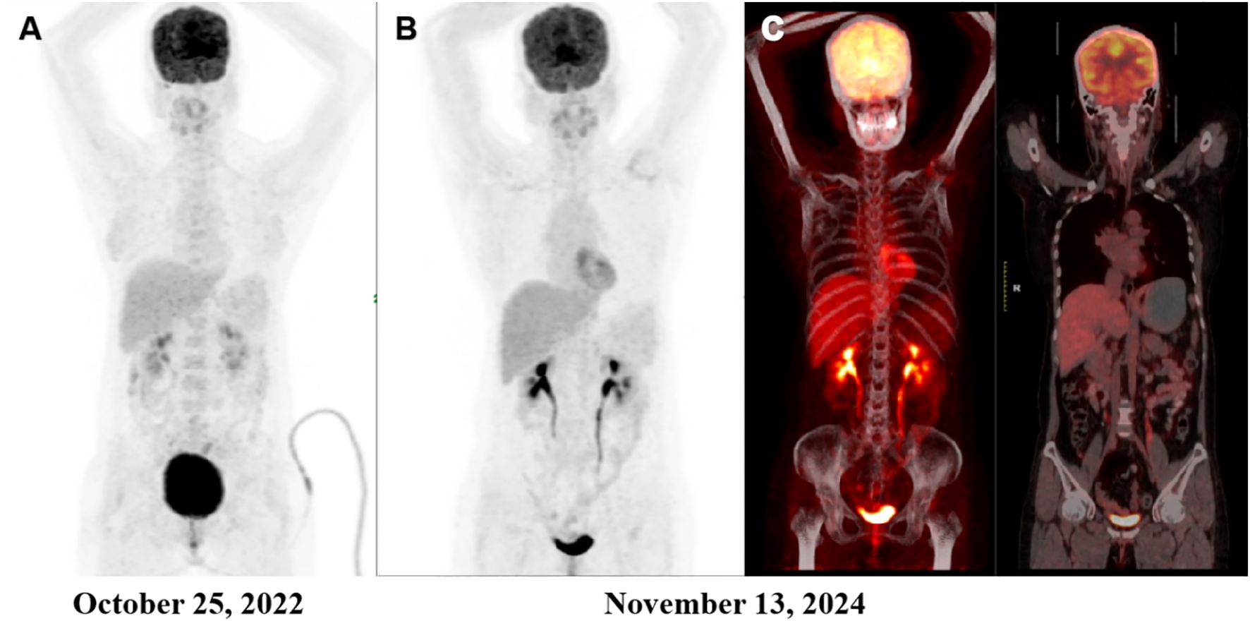 Four-paneled image showing PET scans of a human torso. Panels Comparison of PET/CT scans before and after treatment. Comparison of PET/CT scans before and 19 months after treatment. (A) Preoperative PET/CT shows no hypermetabolic activity in the liver, a 1.6 cm cystic lesion in the right adnexa, and a physiologically active focus in the left adnexa (SUVmax 4.5). (B, C) Post-treatment scans show no abnormal hypermetabolic activity suggesting recurrence.