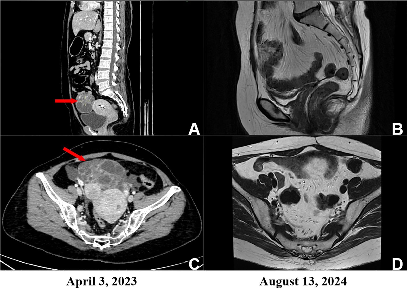 CT and MRI scans showing abdominal images. Panel A displays a sagittal CT view with a red arrow pointing to an area of interest. Panel B shows a sagittal MRI without annotations. Panel C presents an axial CT scan with a red arrow highlighting a specific region. Panel D shows an axial MRI view without annotations. Dates indicated are April 3, 2023, and August 13, 2024.