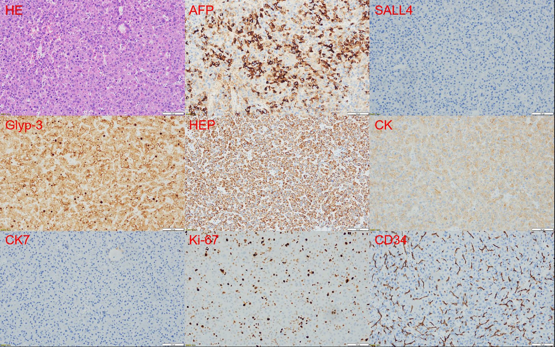Nine-panel microscopic image showing different immunohistochemical stains of a tissue sample. Panels are labeled: HE, AFP, SALL4, Glyp-3, HEP, CK, CK7, Ki-67, and CD34. Each panel shows varying levels of staining intensity and pattern, with different colors and distributions of cells indicated by the specific stain focus.