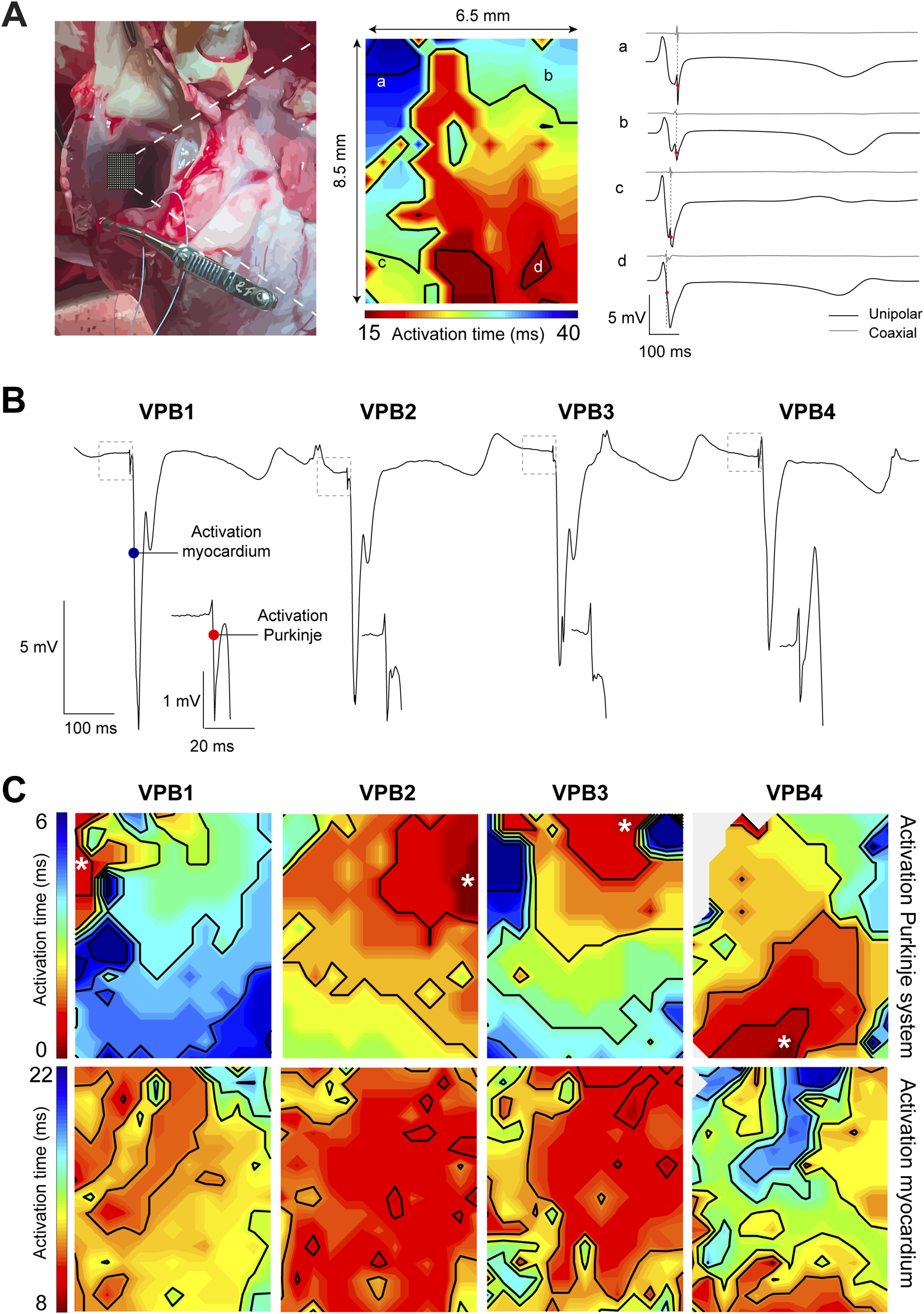 Panel A shows a surgical view with a grid on the heart tissue, a colored activation time map, and corresponding electrograms for points a-d. Panel B presents VPB1-4 waveforms with labeled Purkinje and myocardial activation. Panel C displays activation time maps for VPB1-4, indicating differences in Purkinje system and myocardium activation.