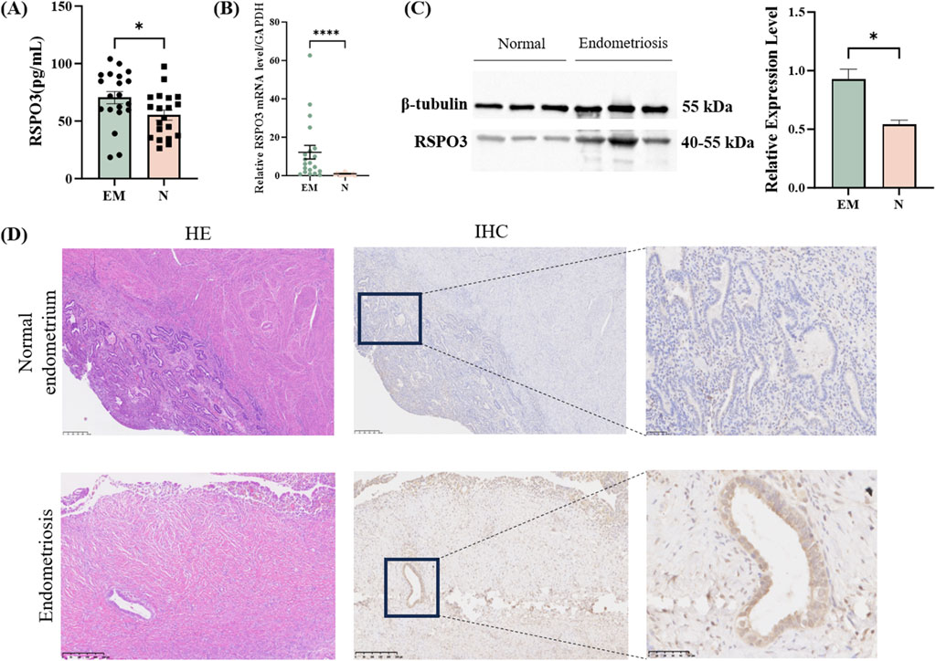 Graphs and images illustrate RSPO3 expression differences between endometriosis (EM) and normal (N) tissues. (A) Bar graph shows higher RSPO3 levels in EM. (B) Dot plot indicates significantly higher RSPO3 mRNA in EM. (C) Western blot and bar graph illustrate RSPO3 protein levels, higher in EM. (D) Histological images: hematoxylin and eosin (HE) staining shows tissue structures, and immunohistochemistry (IHC) highlights RSPO3 expression, more pronounced in endometriosis samples.