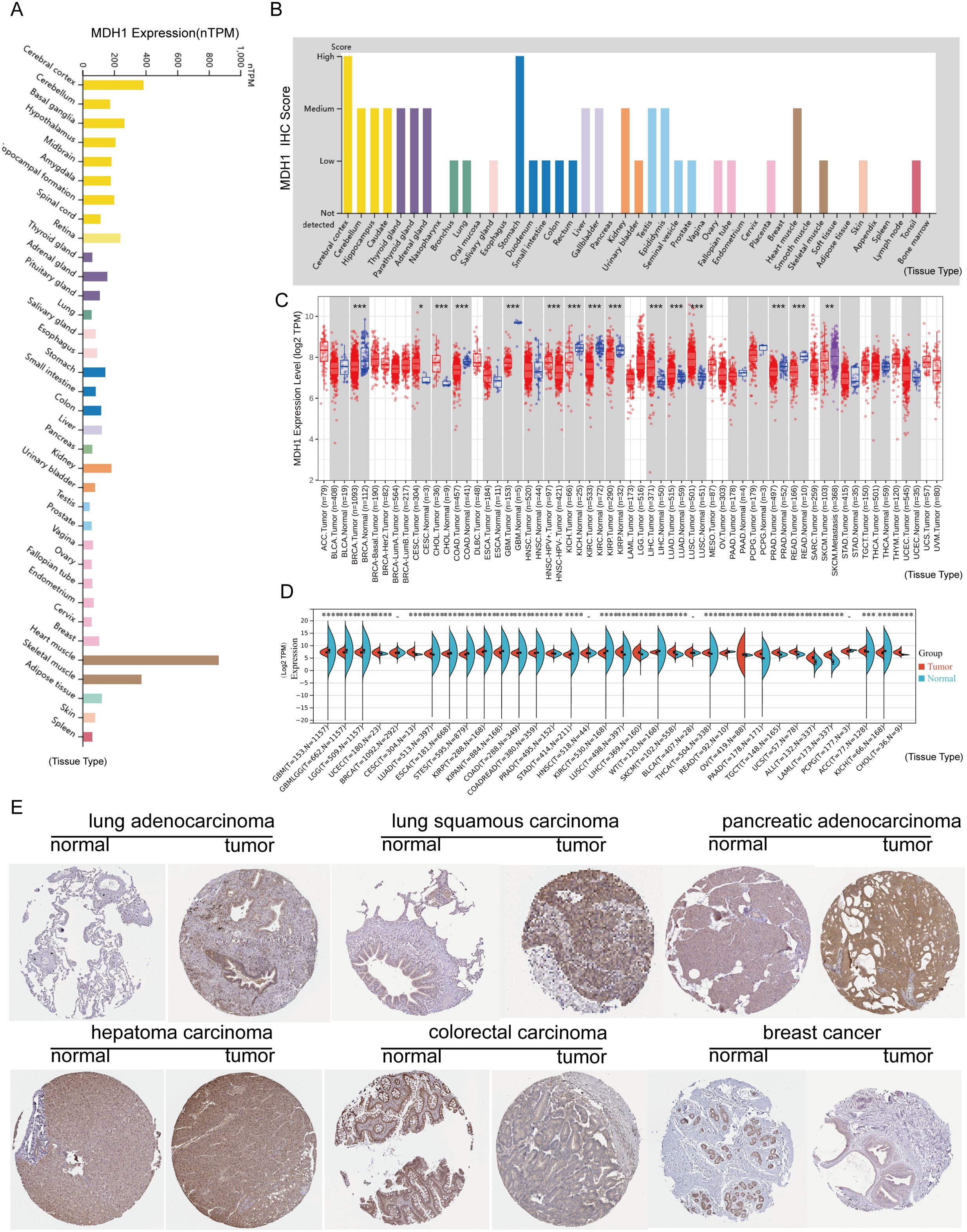 Bar chart A shows tissue-specific expression scores across various human tissues, with cerebral cortex and pancreas scoring highly. Bar chart B categorizes the expression levels of MDH1 across different tissues, with varying scores from high to not detected. Graph C illustrates MDH1 expression levels in log2 TPM across several cancer types, highlighting significant differences. Violin plot D compares expression levels of MDH1 in tumor and normal samples, showing distributions with marked significance. Images in panel E display histological sections of lung adenocarcinoma, lung squamous carcinoma, pancreatic adenocarcinoma, hepatoma, colorectal carcinoma, and breast cancer, comparing normal and tumor tissues.