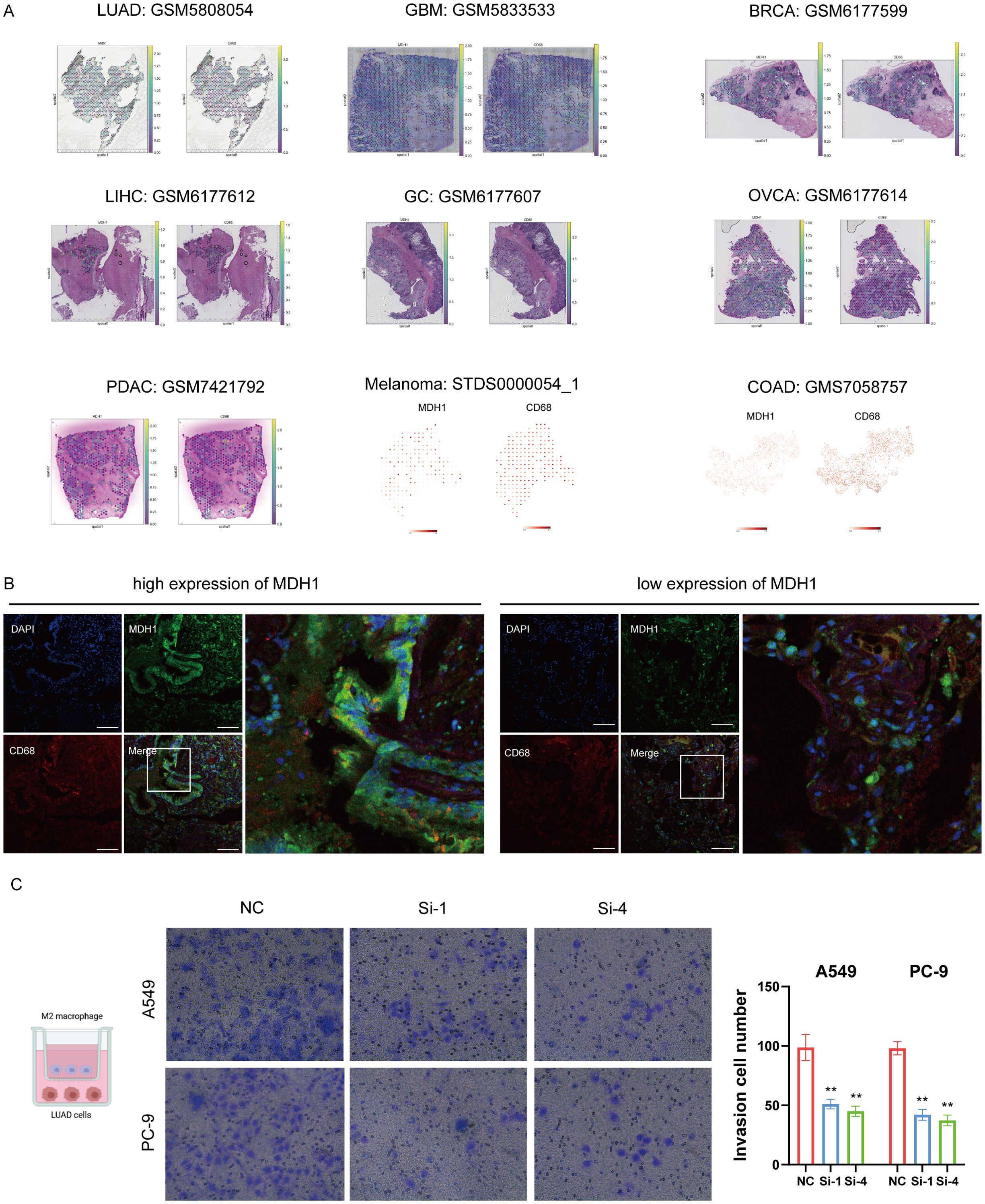 Panel A shows histological images of various cancer tissues with respective sample IDs, depicting staining patterns. Panel B includes fluorescent microscopy images comparing high and low MDH1 expression with DAPI and CD68 markers. Panel C displays a diagram of an invasion assay with macrophages and LUAD cells, followed by microscopic images showing cell invasion results for A549 and PC-9 cell lines under different treatments (NC, Si-1, Si-4), accompanied by a bar graph illustrating invasion cell numbers with statistical significance.