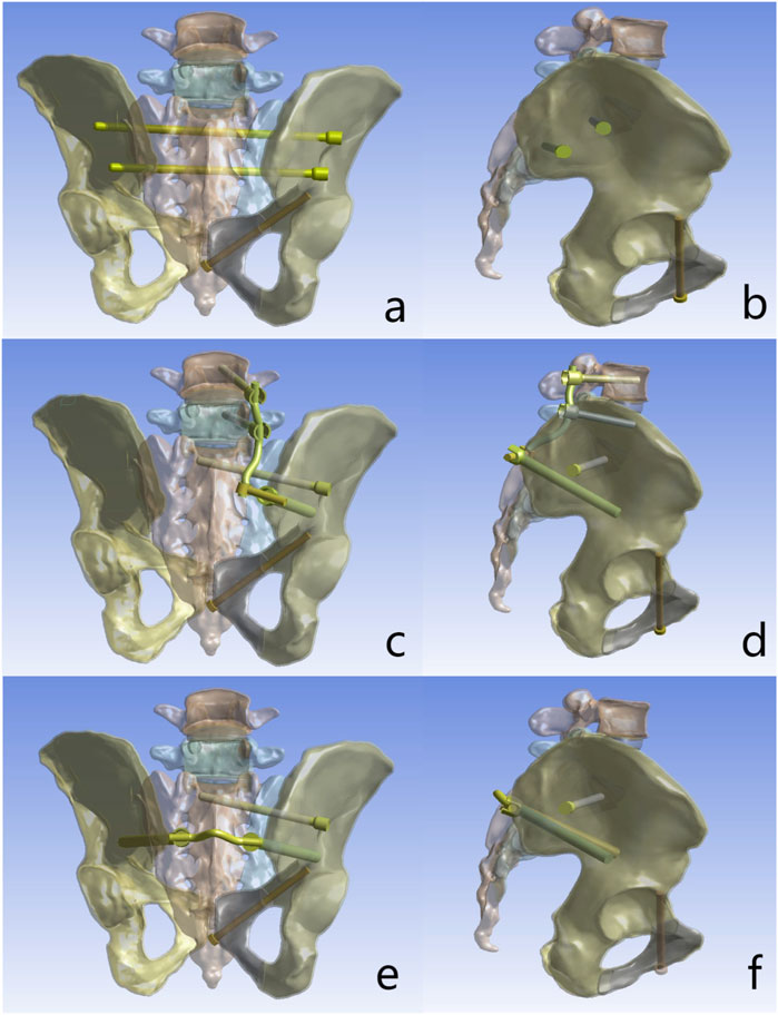 Six panels labeled a to f show 3D renderings of a pelvic bone with various internal fixation devices. Panels a, c, and e depict an anterior view, while panels b, d, and f show a lateral view. Yellow rods and screws are visible, highlighting different fixation techniques across the images.