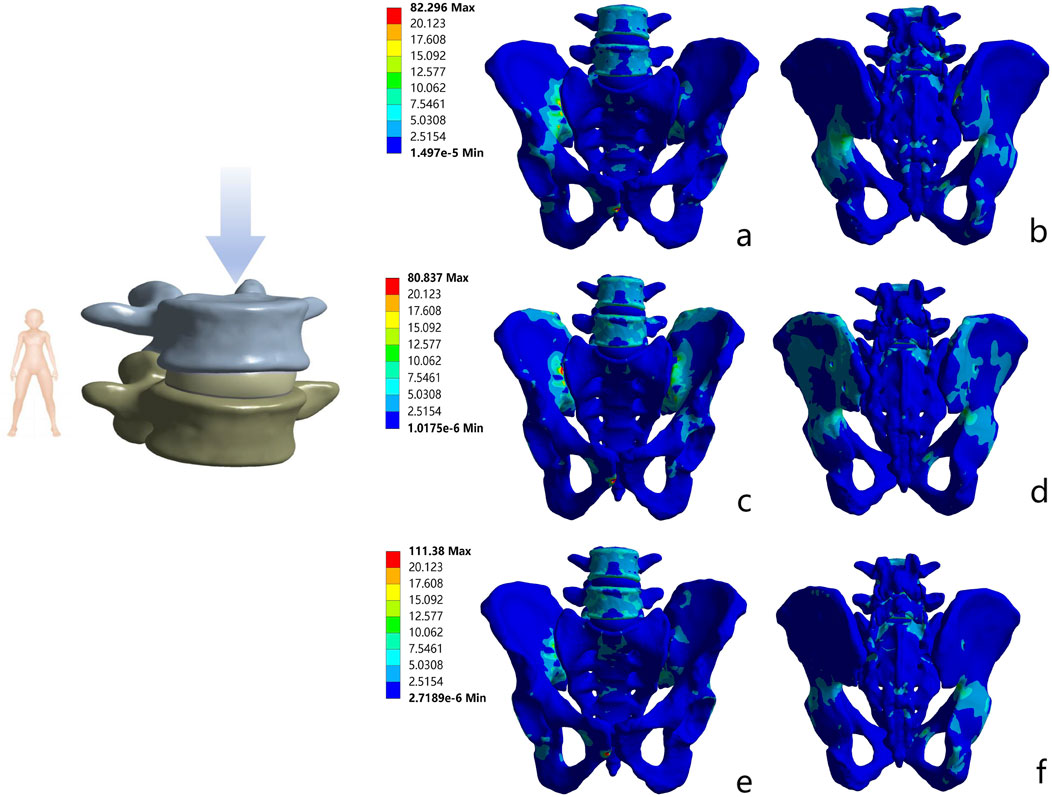 Illustration showing a spinal model with an arrow indicating pressure applied to vertebrae. Next to it are six color-coded stress distribution diagrams (a-f) for pelvic bones, featuring blue as low stress and red as high stress. A scale bar displays stress values, ranging from approximately 1.5e-6 to 111.38, with human figure for scale.