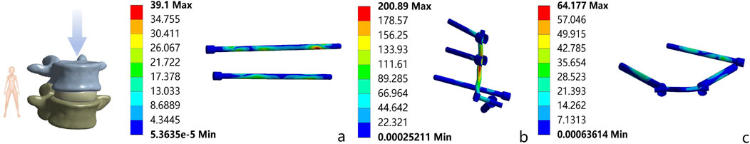 Three panels labeled a, b, and c display simulated stress distribution on spinal components, indicated by color gradients from blue (low stress) to red (high stress). Panel a shows vertebrae with an applied force, panel b illustrates stress on connecting rods, and panel c depicts a stabilization device. Each panel includes respective color scales with numerical stress values.