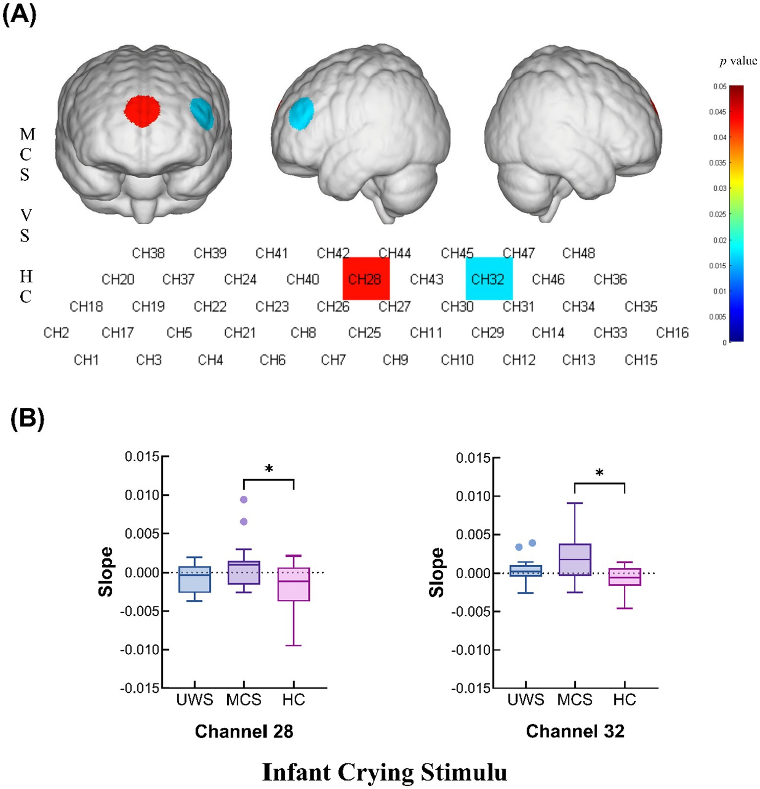 (A) Illustration of brain topography highlighting Channels 28 and 32 in red and blue, respectively. A color scale indicates p-values from 0.01 to 0.05. (B) Two box plots show slope values for Channels 28 and 32 across conditions: Unresponsive Wakefulness State (UWS), Minimally Conscious State (MCS), and Healthy Controls (HC), with significant differences marked by asterisks.