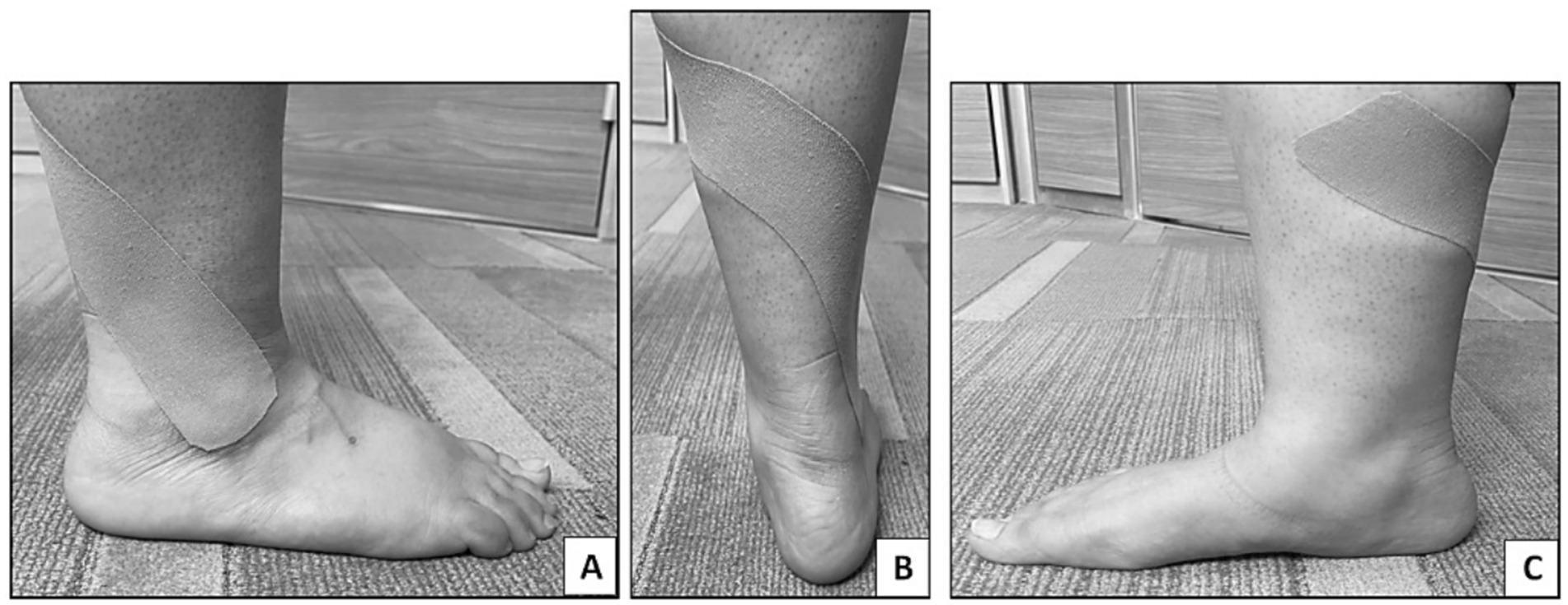 Three black and white images labeled A, B, and C showing a foot wrapped with kinesiology tape. Image A shows a side view of the foot and ankle. Image B shows a rear view, emphasizing the heel and lower leg. Image C shows a side view of the leg, displaying the tape’s placement on the calf.