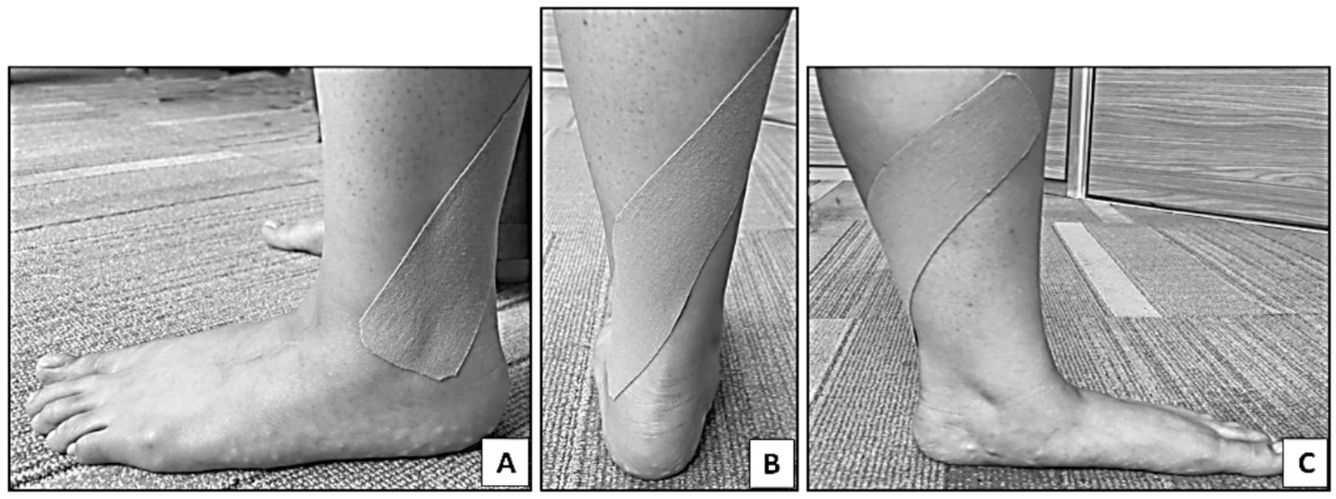 Three-panel image showing an ankle with kinesiology tape applied. Panel A shows tape on the inner side of the foot. Panel B displays the tape extending upward along the calf. Panel C illustrates a profile view of the foot with tape from heel to calf.