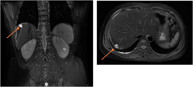 MRI scans showing two different views of similar areas in the body. In both images, orange arrows point to bright spots which may indicate areas of interest or abnormality within the tissues. The first image is a coronal view, and the second is an axial view.