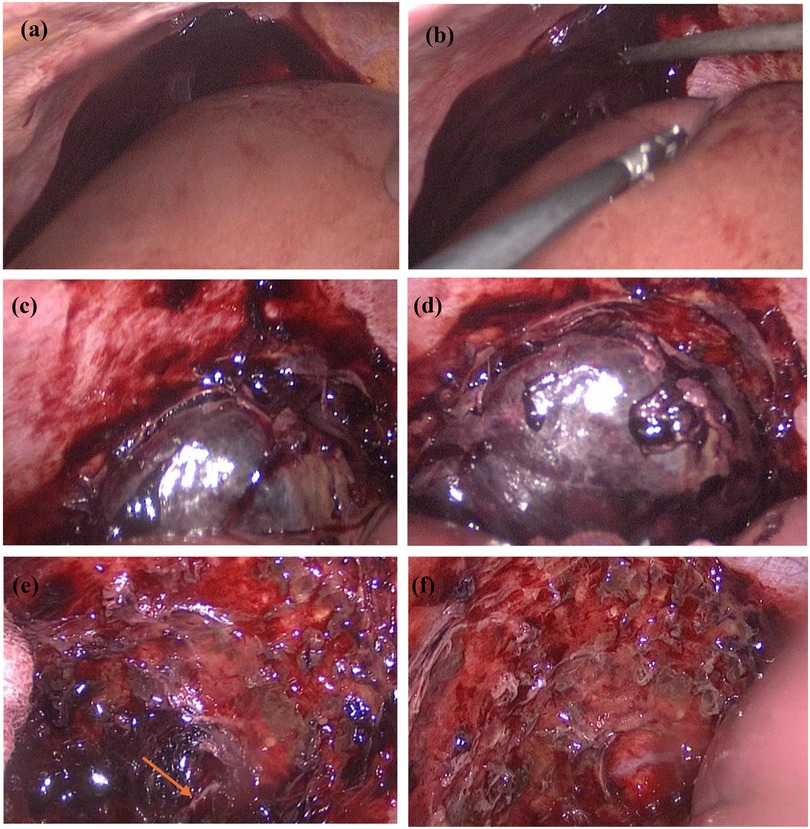 Six-panel medical image series showing a surgical procedure. Panel 1 displays an initial incision. Panel 2 shows surgical tools in use. Panels 3 and 4 focus on the exposed tissue and dark mass within. Panel 5 highlights a specific area indicated by an arrow. Panel 6 shows the tissue area post-procedure, with visible changes.