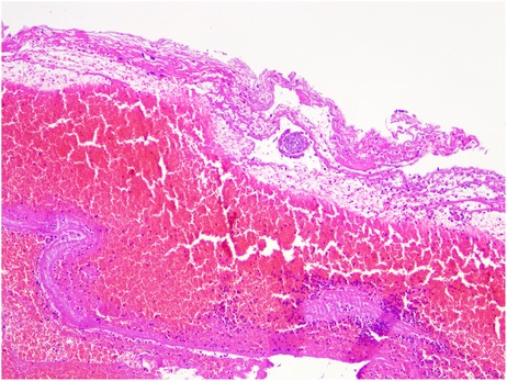 Microscopic image of tissue from the diaphragmatic lesion, stained in shades of pink and purple. The image shows chorionic villi and trophoblastic cells, which are diagnostic histological features of ectopic pregnancy, confirming the presence of pregnancy tissue on the diaphragmatic surface.