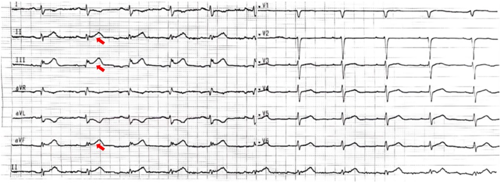 Electrocardiogram displaying traces from multiple leads, with red arrows highlighting elevated ST segments in leads II, III, and aVF, suggesting possible inferior myocardial infarction.