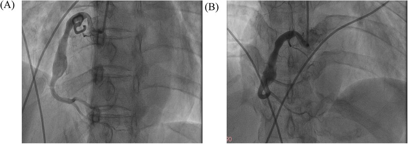 Two-panel medical images labeled A and B. Panel A shows an angiogram with coiling in a blood vessel, indicating possible blockage or aneurysm treatment. Panel B depicts a similar angiogram with a less complex coil structure, possibly indicating a different stage of treatment or a separate vessel.