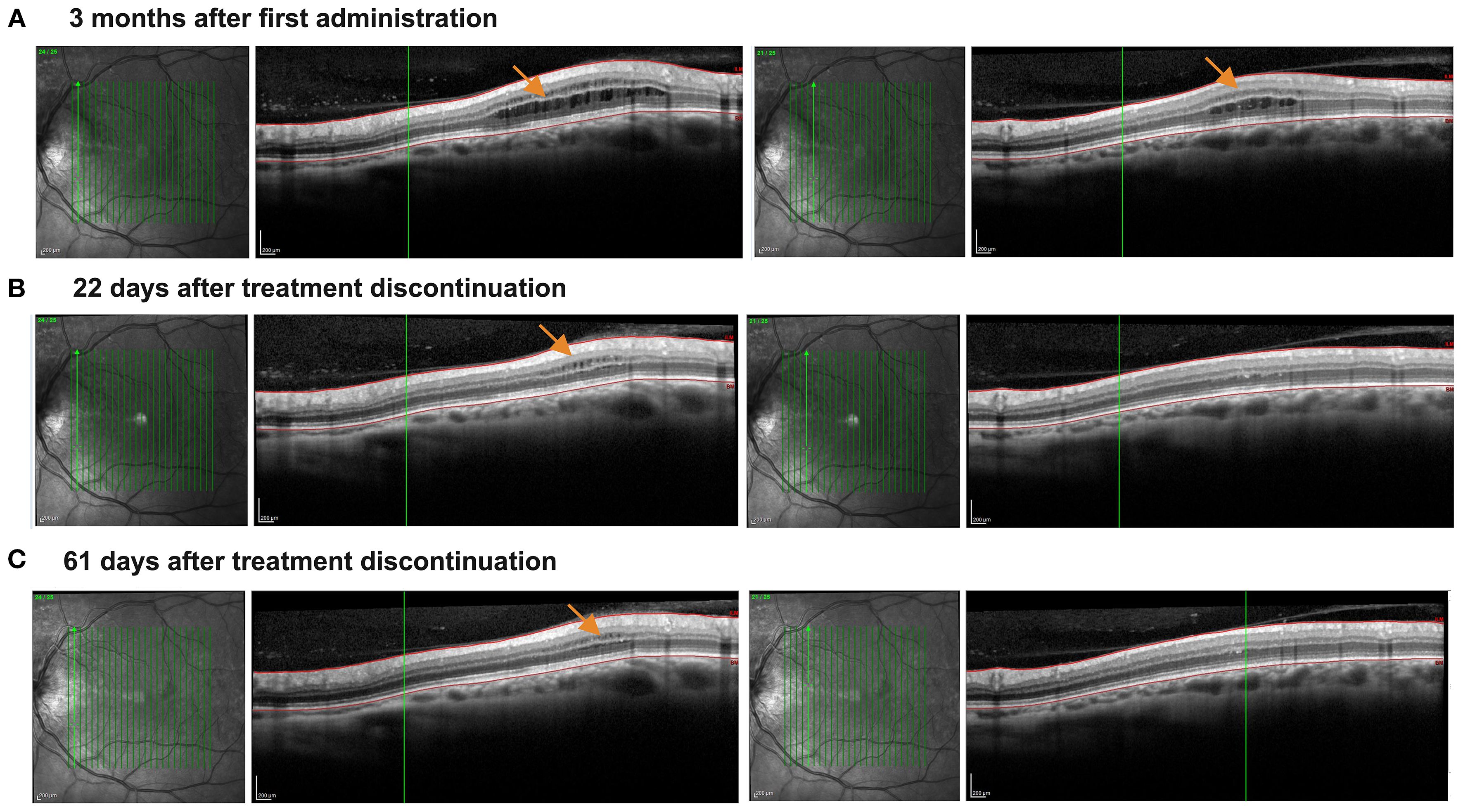 Three panels comparing retinal scans. Panel A shows the scan three months after first administration, with an arrow pointing to fluid. Panel B shows the scan twenty-two days after treatment discontinuation, with fluid reduction. Panel C shows the scan sixty-one days after treatment discontinuation, indicating further fluid reduction. Each panel consists of an infrared image with green gridlines and a cross-sectional OCT scan with highlighted areas.