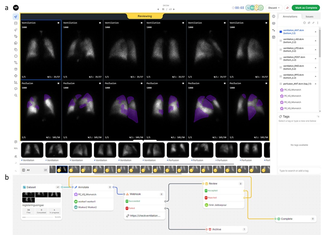 Medical imaging software interface showing ventilation and perfusion scans. The top section features multiple lung images with gradient shading and purple overlays in perfusion scans. The panel to the right displays a list of annotated files. The bottom section illustrates a workflow diagram with processes titled Dataset, Annotate, Webhook, Review, and Archive, connected sequentially.