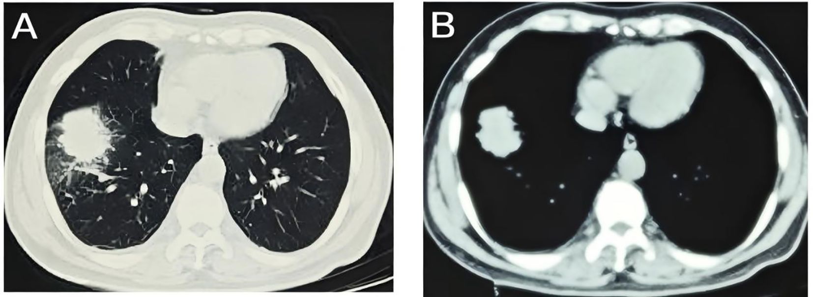 Two CT scan images labeled A and B show cross-sections of the chest. Image A shows lung opacities in both lungs, indicating potential abnormalities. Image B has a clearer view with fewer opacities.
