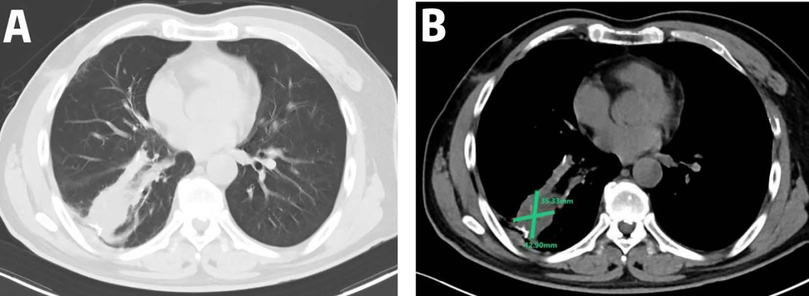 CT scan images showing two axial chest views. Image A displays a clear view of the lungs and heart. Image B illustrates measurements of a mass or lesion near the heart, marked as 35.33 millimeters by 42.90 millimeters.