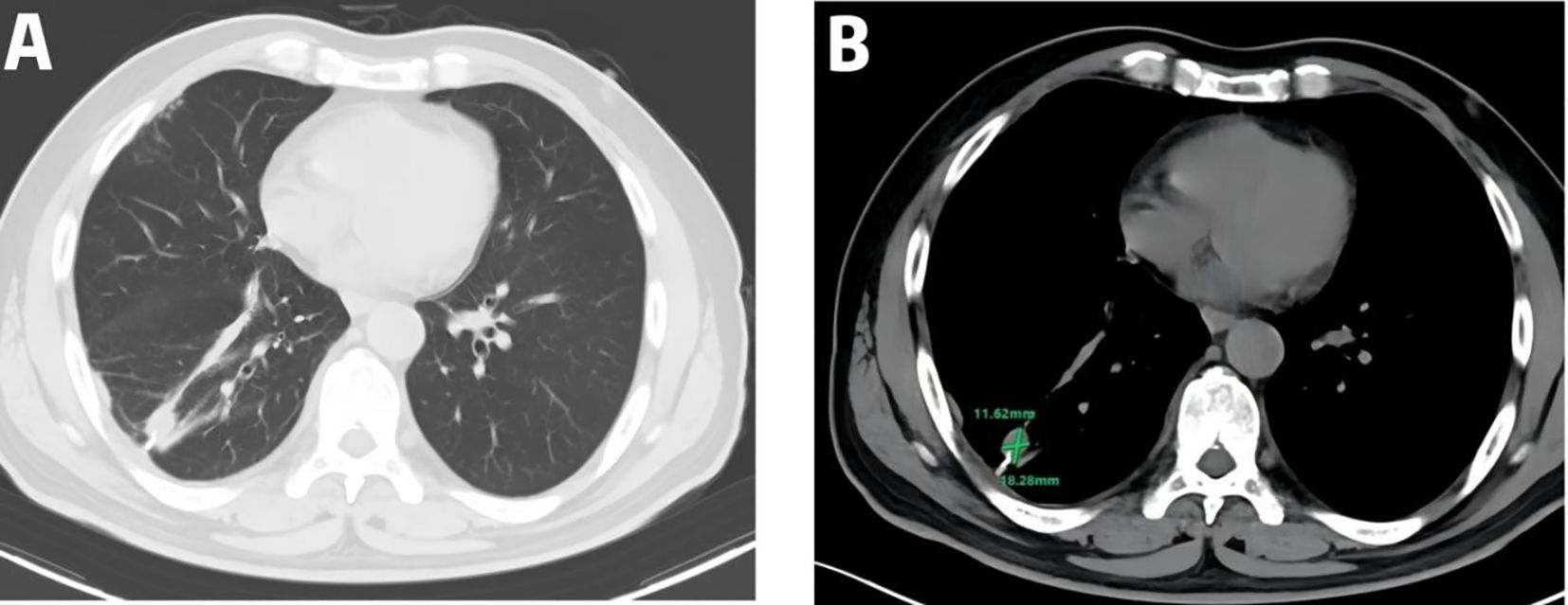 Two-panel CT scan images of a chest. Panel A shows a lighter grayscale image with visible lung structures and heart. Panel B shows a darker image with measurements indicated, highlighting a specific area near the heart.
