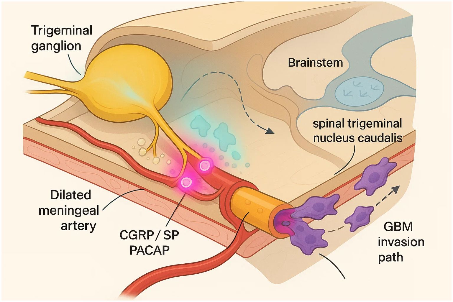 Diagram illustrating the trigeminal ganglion, dilated meningeal artery, and brainstem. Shows pathways involving CGRP, SP, PACAP, spinal trigeminal nucleus caudalis, and GBM invasion path with arrows indicating direction.