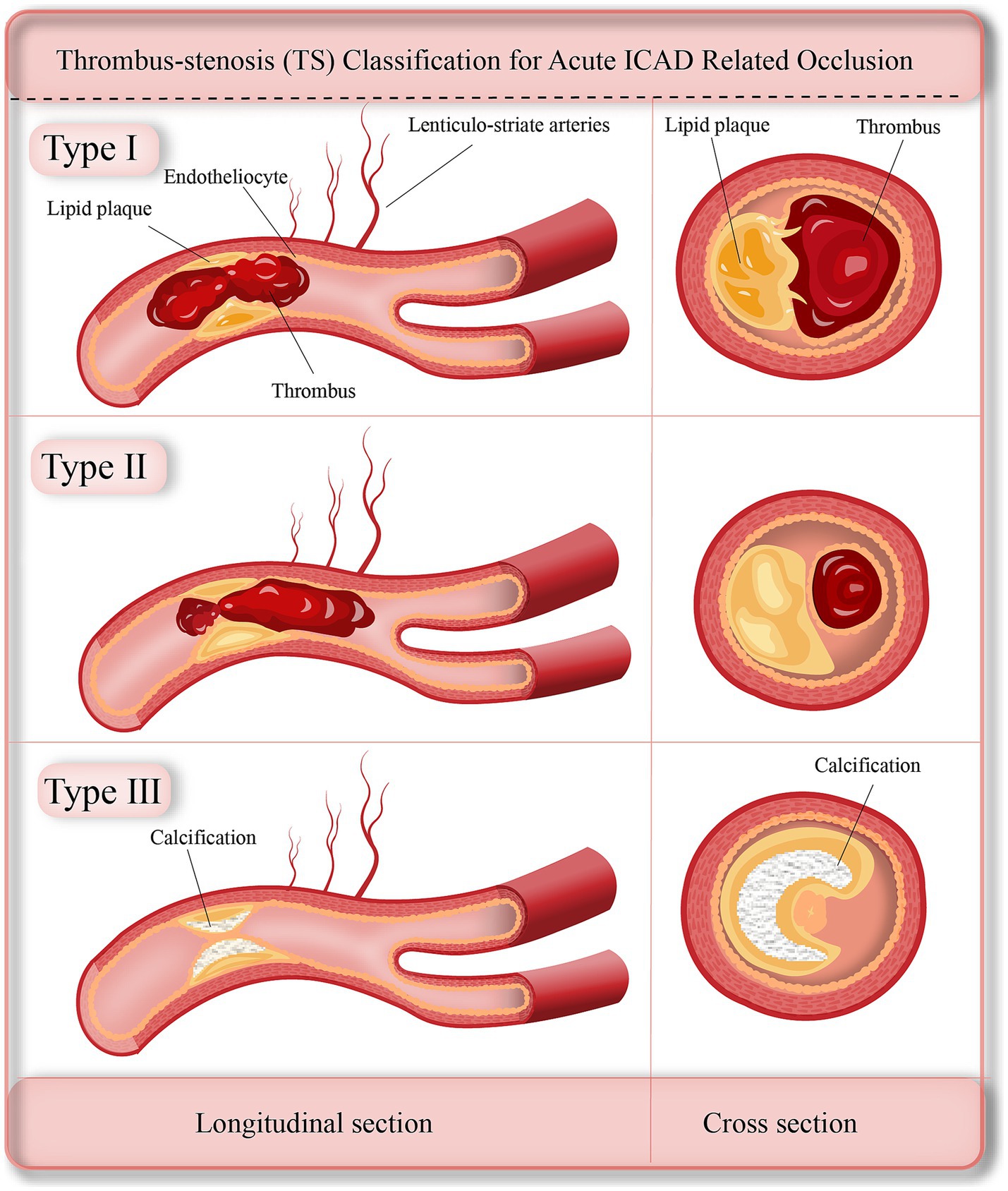 Classification diagram for thrombus-stenosis in acute ICAD occlusion, showing three types. Type I features lipid plaque and thrombus. Type II shows a larger thrombus. Type III presents calcification. Each type includes longitudinal and cross-sectional views, highlighting structural differences.