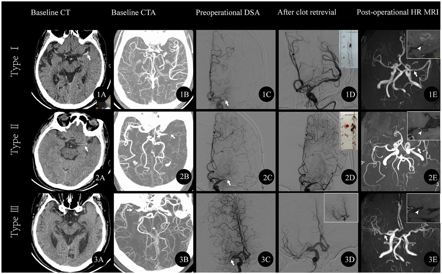 Medical imaging comparison of three types of conditions. Each row shows a patient's baseline CT scan, baseline CTA, preoperative DSA, post-clot retrieval DSA, and post-operative MRI. The images highlight different stages of treatment, marked with arrows and annotations for clarity.