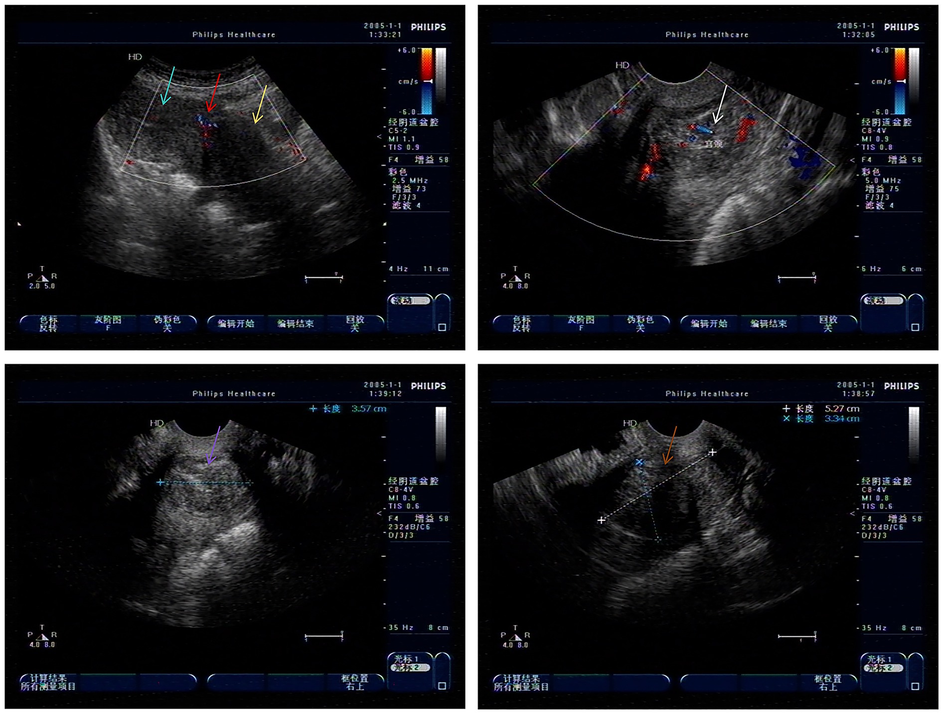 Ultrasound images displaying abdominal cross-sections with various measurements and annotations marked by colored arrows. The screens show color Doppler imaging and accompanying measurement data, indicating blood flow and dimensions in centimeters for different anatomical areas. The images include settings and technical details from the ultrasound machine.