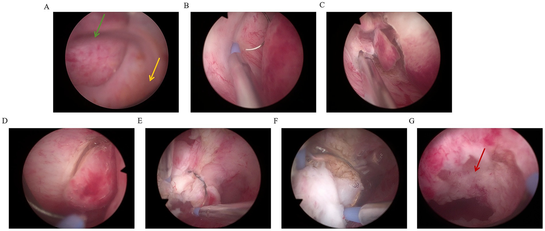 Seven endoscopic images labeled A to G show different stages of a knee arthroscopy procedure. Arrows in some images highlight specific tissues or instruments involved in each step. Images primarily exhibit pinkish tissue within the joint, with variations in texture and appearance indicating different procedural stages.