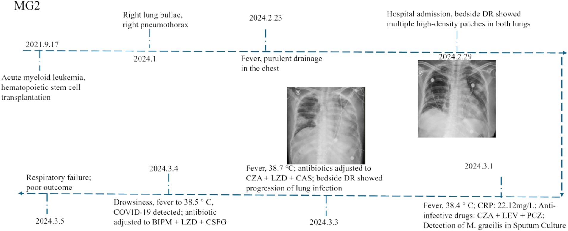 Timeline of a patient with acute myeloid leukemia from September 2021 to March 2024, showing medical events and treatments. Key events include right lung issues, fever, purulent chest drainage, COVID-19 detection, respiratory failure, and antibiotic treatments. Includes chest X-rays from February 2024 indicating multiple high-density patches and lung infection progression.