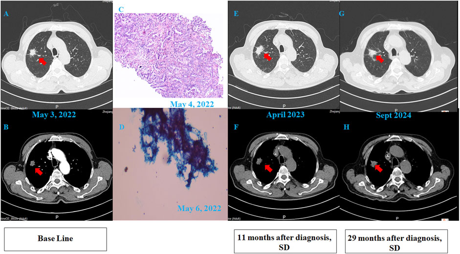 CT scans and histological images show a lesion in the lung across multiple dates. Panels A, B, E, F, G, and H are CT scans from May 3, 2022, April 2023, and September 2024, marked with red arrows indicating the lesion’s location. Panels C and D show histological slides from May 4 and 6, 2022. Captions indicate diagnosis timelines: baseline, and 11 and 29 months after diagnosis, with notes of stable disease (SD).