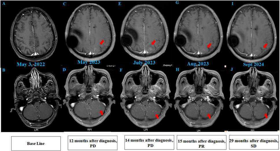 MRI scans showing axial views of the brain over time. Panels A and B from May 3, 2022 show baseline images. Panel C and D, 12 months after diagnosis, indicate progression with red arrows. Panels E and F, July 2023, show continued progression. Panels G and H, August 2023, reflect further changes. Panels I and J, September 2024, show stabilized disease, marked as