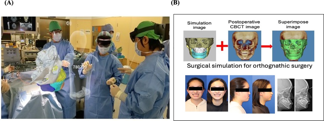 Two-panel figure illustrating the use of digital technologies in orthognathic surgery. Panel A shows a surgical team in an operating room wearing mixed reality headsets and interacting with a holographic 3D model of a skull projected above the patient. Panel B depicts a surgical simulation workflow: a simulation image is combined with a postoperative CBCT image to produce a superimposed image for outcome evaluation. Below are pre- and post-surgical photographs and lateral X-rays of a patient, demonstrating facial and skeletal changes resulting from orthognathic surgery.