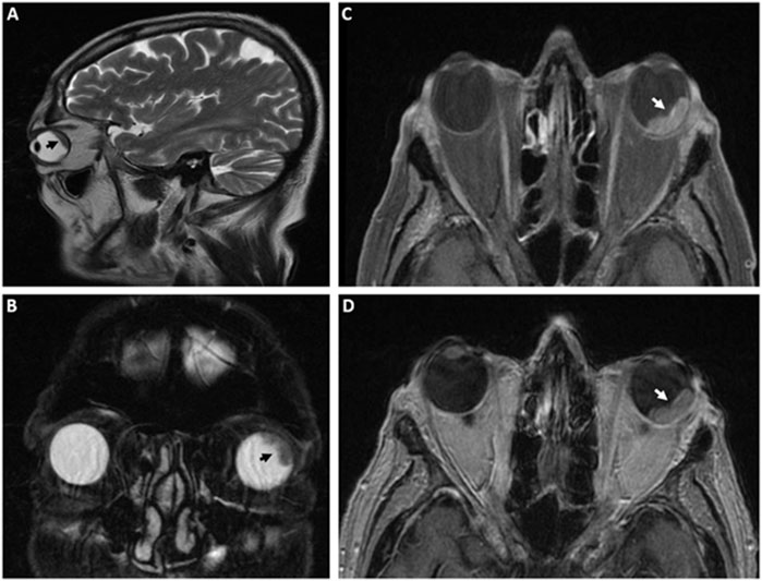 MRI images of the brain and eyes are shown in four panels labeled A, B, C, and D. Panel A is a sagittal view highlighting a structure in the brain with an arrow. Panels B, C, and D display axial views of the eyes, each with arrows pointing to specific areas of interest, likely indicating abnormalities or focal points for further examination.