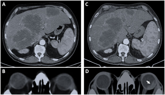 CT scans showing axial views of the abdomen (panels A and C) and orbits (panels B and D). Panel A shows an abdominal mass, while panel C shows its progression or change. Panel B shows an orbit image with a normal view, and panel D highlights a lesion or abnormality with an arrow.