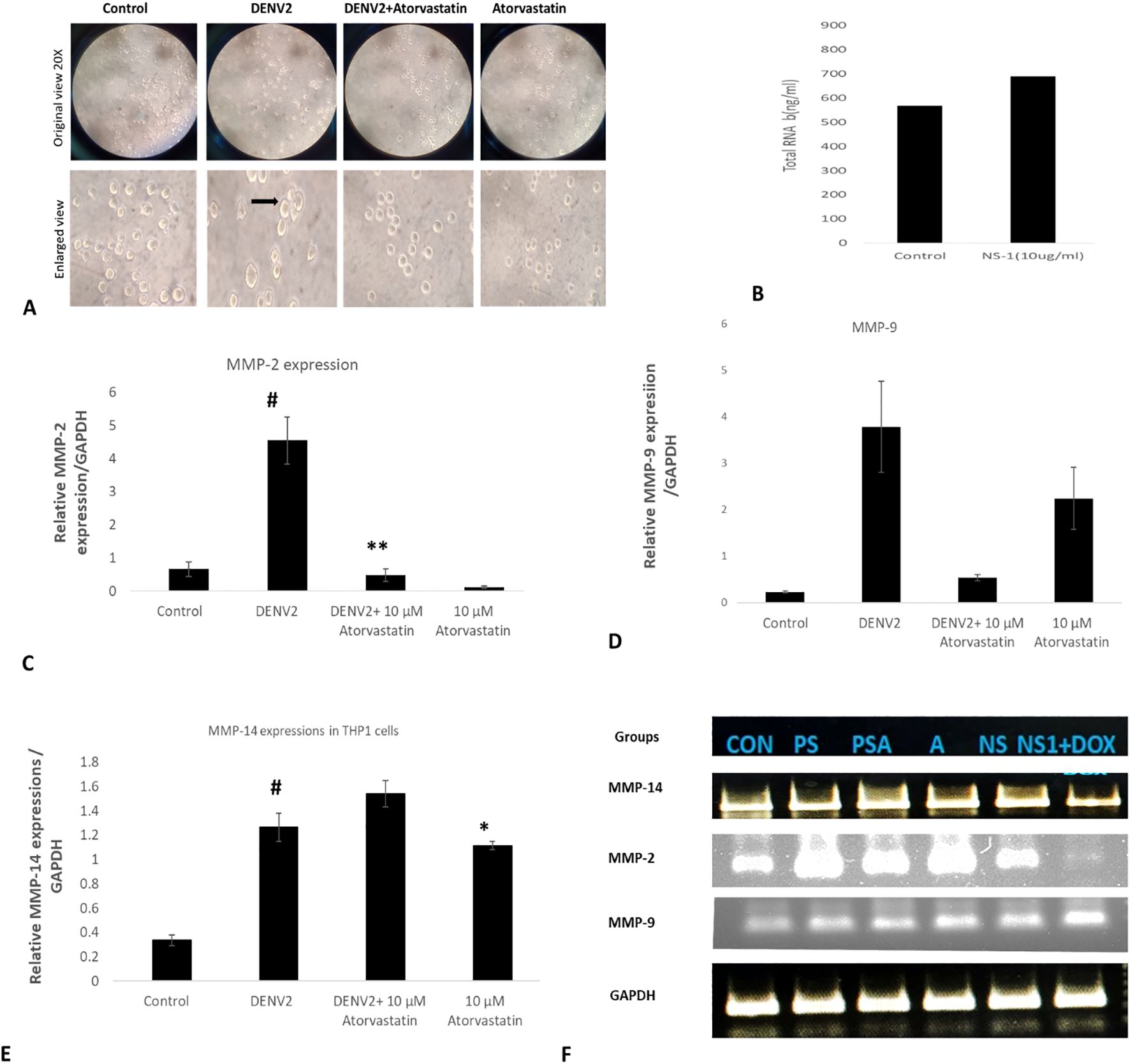 Microscopic images and bar graphs depict the effects of DENV2 infection and atorvastatin. Panel A shows cellular changes under different treatments. Panel B presents a bar graph of total RNA levels comparing control and NS-1 treatments. Panel C illustrates MMP-2 expression across various conditions, with DENV2 showing significant increase. Panel D highlights MMP-9 expression, elevated by DENV2. Panel E shows MMP-14 expression in THP1 cells, increased with DENV2. Panel F provides Western blot images for MMP-14, MMP-2, MMP-9, and GAPDH across different groups, illustrating protein level changes.