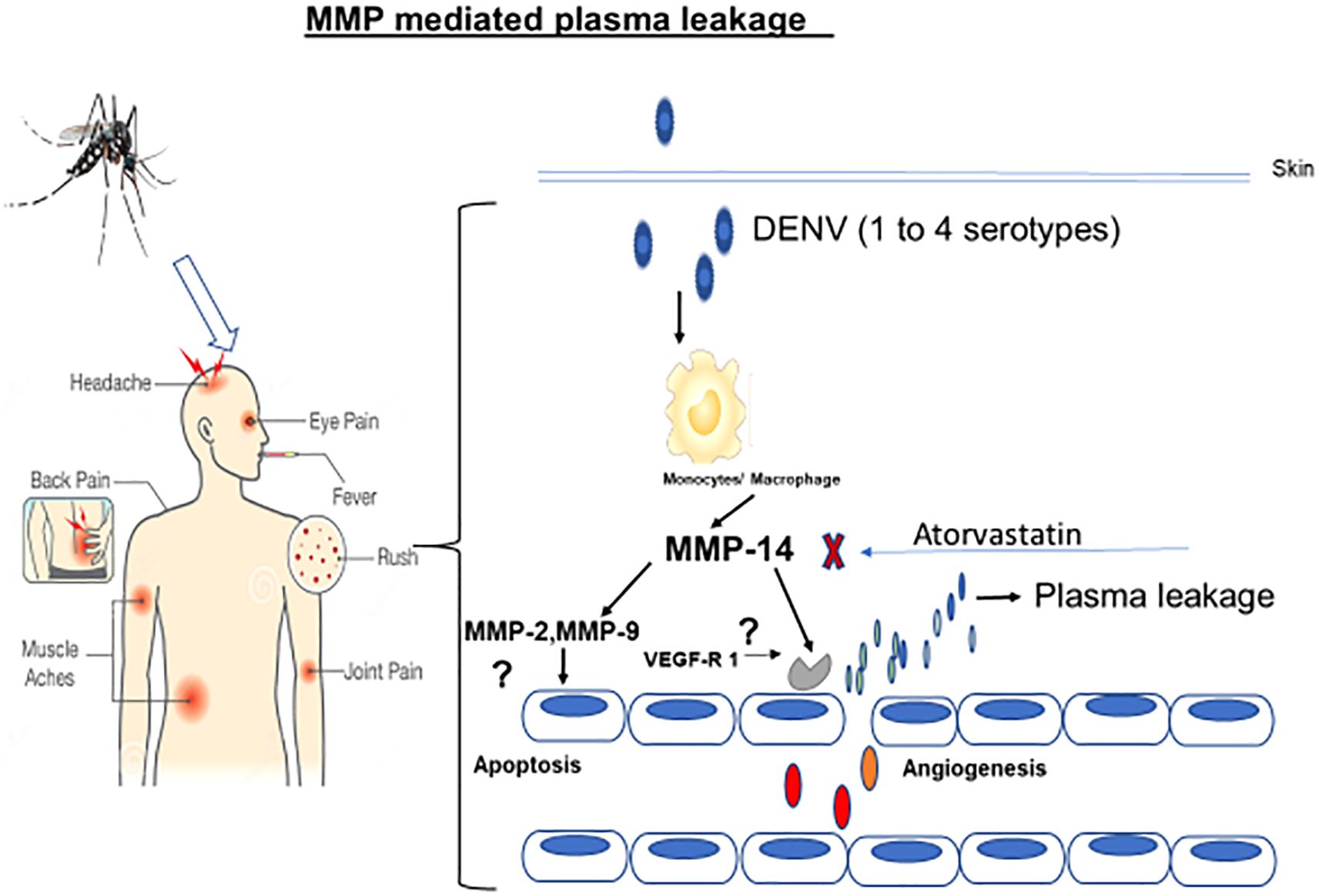 Diagram illustrating MMP-mediated plasma leakage. A mosquito indicates the dengue virus transmission, causing symptoms: headache, eye pain, muscle aches, back pain, fever, joint pain, and rash. Dengue virus (DENV) targets monocytes/macrophages, activating MMP-14, leading to plasma leakage via MMP-2 and MMP-9, affecting apoptosis and angiogenesis. Atorvastatin inhibits this process.