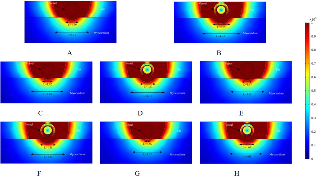 Eight thermal distribution diagrams labeled A to H depict the heat map around a blood vessel within fat and myocardium layers. Each diagram shows varying heat intensities from red to blue, with arrow-labeled measurements indicating distances, L, under specified conditions. Color gradient values are represented on the right from zero to one thousand.