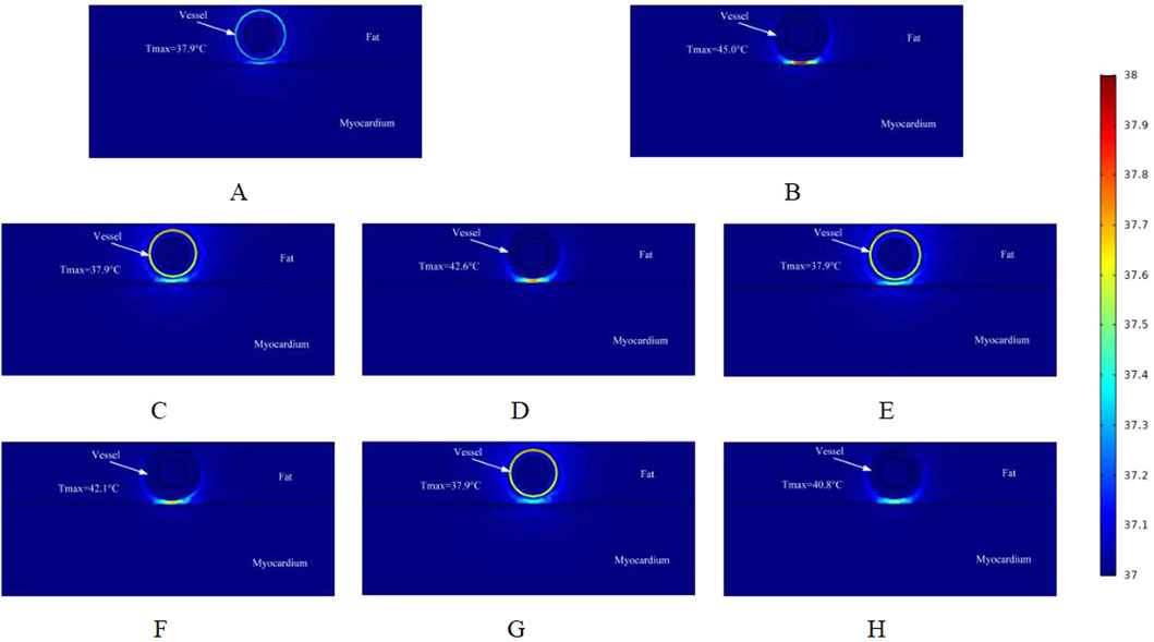 Eight thermal images labeled A to H show color-coded temperature distributions around a vessel, fat, and myocardium. They display varying Tmax (maximum temperatures), indicated beside each vessel. A color scale on the right ranges from red (38 degrees Celsius) to blue (37 degrees Celsius), demonstrating temperature variations.