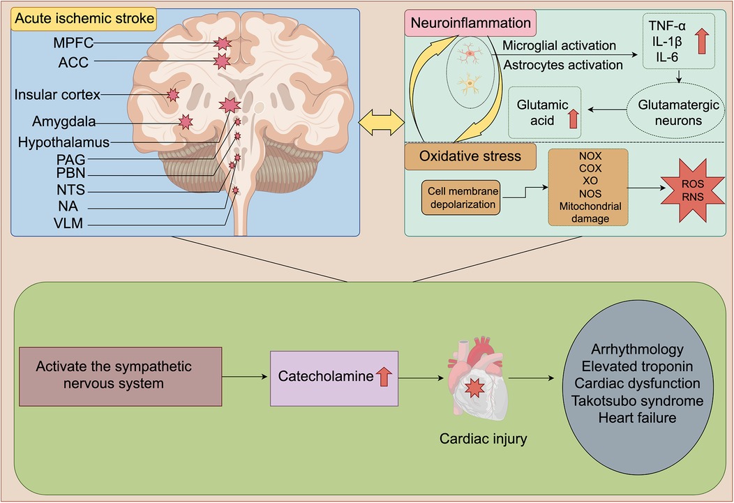 Diagram illustrating the effects of acute ischemic stroke on the brain and heart. The brain section shows affected regions like the MPFC and ACC, leading to neuroinflammation and oxidative stress. This process involves microglial and astrocytes activation, increased glutamic acid, and damage from reactive oxygen and nitrogen species. The pathway leads to activation of the sympathetic nervous system, raising catecholamine levels, resulting in cardiac injury. The cardiac impact includes arrhythmology, elevated troponin, cardiac dysfunction, Takotsubo syndrome, and heart failure.