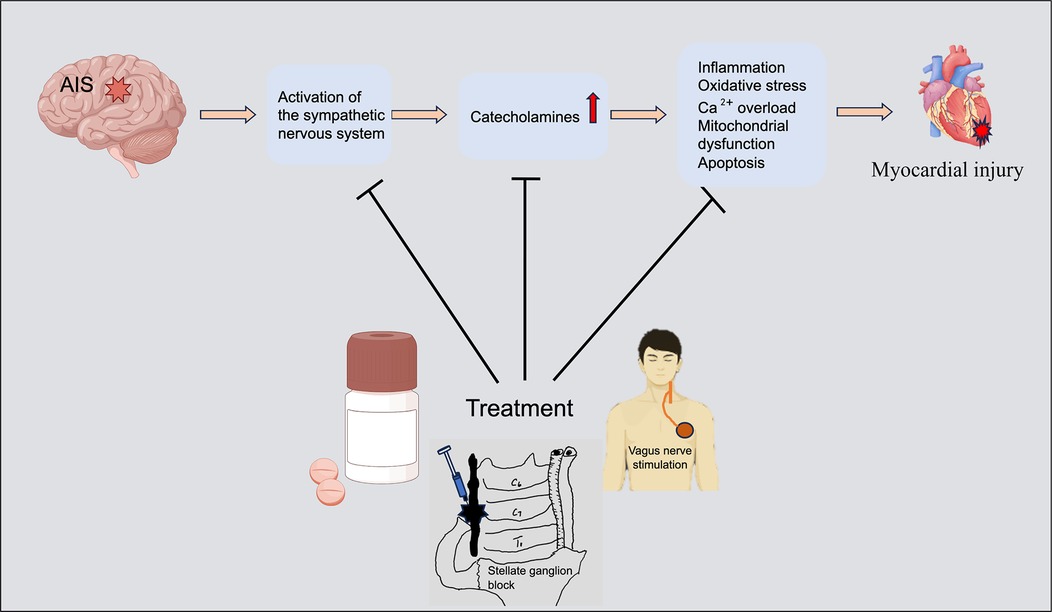 Diagram illustrating the pathophysiological process from acute ischemic stroke (AIS) to myocardial injury. AIS activates the sympathetic nervous system, increasing catecholamine levels, which leads to inflammation, oxidative stress, calcium overload, mitochondrial dysfunction, and apoptosis, resulting in myocardial injury. Treatment interventions shown include medication, stellate ganglion block, and vagus nerve stimulation, each targeting different points in the pathway to mitigate adverse cardiac outcomes.