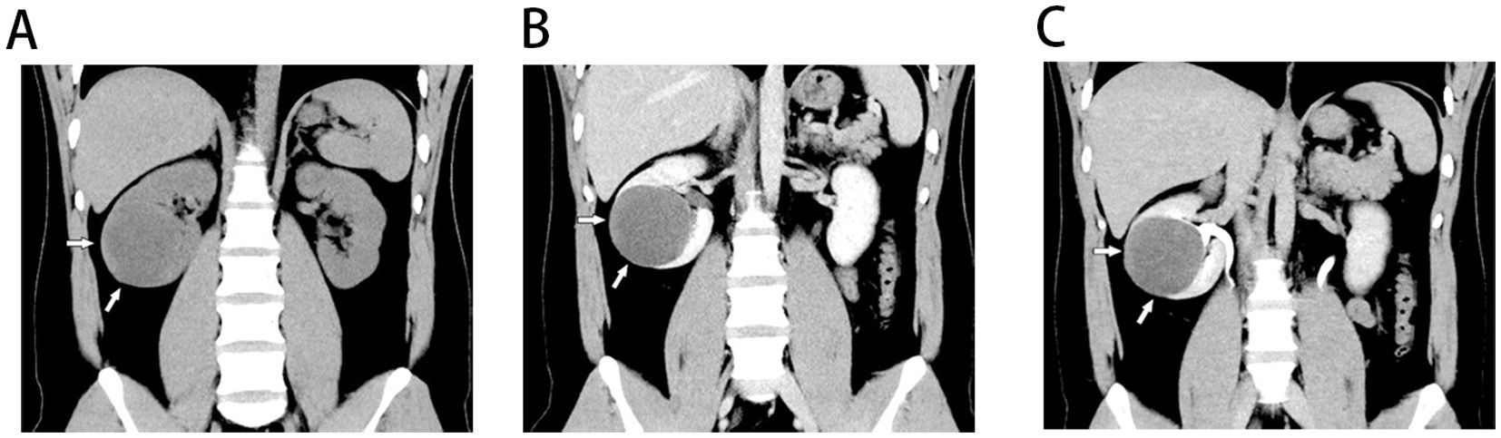 CT images labeled A, B, and C show a large hepatic lesion with arrows indicating specific areas of interest. The lesion appears as a well-defined, round mass in each image, located near the liver. The surrounding organs and spinal column are also visible.