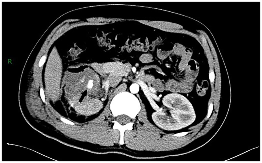 CT scan of the abdomen showing a transverse section. Organs visible include parts of the liver, kidneys, and surrounding tissues. An arrow points to an area of interest on the left side, possibly indicating an abnormality.