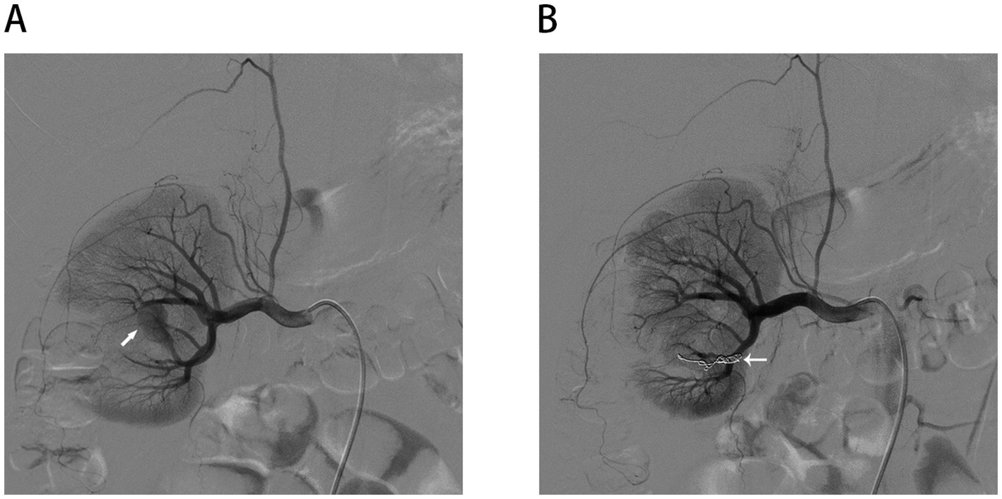 Angiography images showing liver arteries. Image A displays the blood vessels with a white arrow indicating a specific area. Image B shows the same vessels post-intervention, with a white arrow highlighting a placed device.